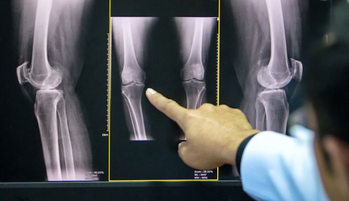 A térd osteoarthritis hatékony diagnosztizálása tomoszintézissel
